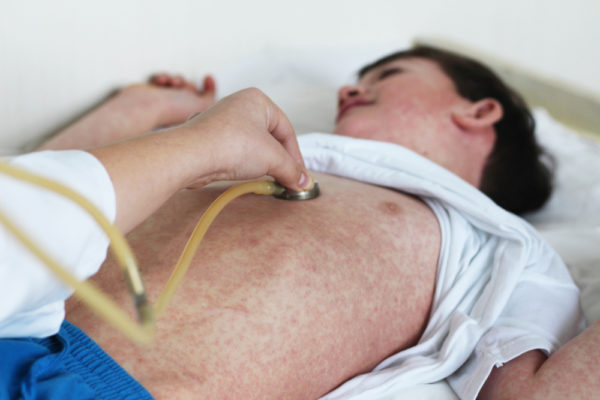 OMS: Casos de sarampión aumentan rápidamente a nivel mundial