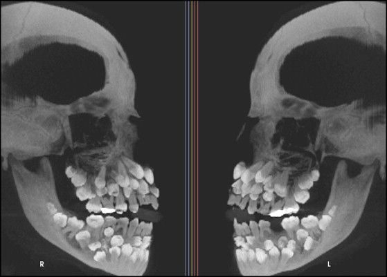 Un dentista removió 526 dientes de la boca de un niño de 7 años