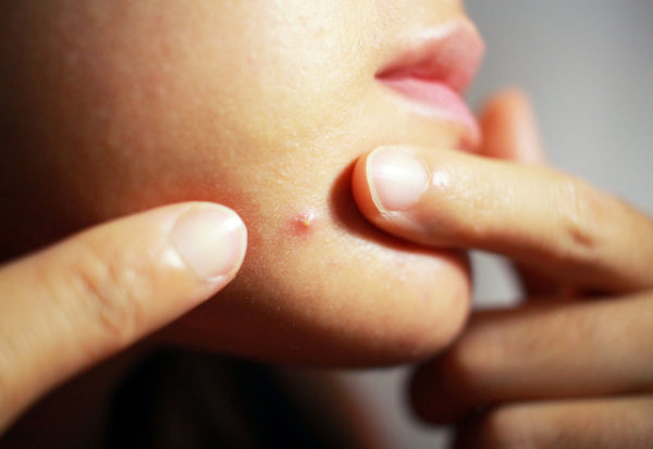 El estrés no es el responsable del acné pero ayuda a su aparición
