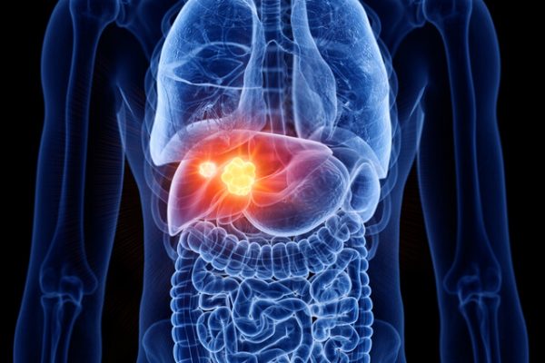 ¿Cómo saber qué personas con hígado graso tienen mayor riesgo de padecer cáncer hepático?