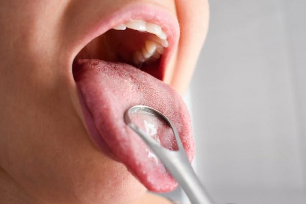 Las caries causan enfermedades fuera de la boca
