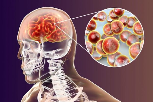 Meningitis: ¿cómo podemos acabar con esta enfermedad mortal?