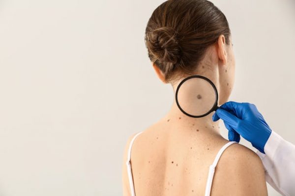 El melanoma: un cáncer duro de pelar