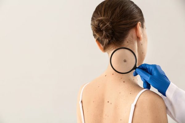 El melanoma: un cáncer duro de pelar