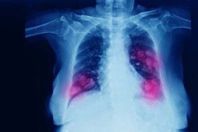 La edición genética podría desactivar uno de los principales culpables del cáncer de pulmón