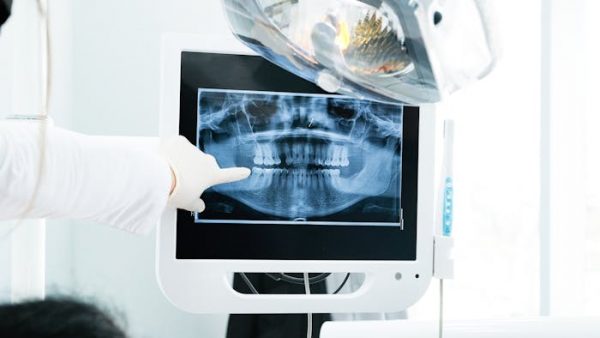 ¿La caries avanza o se detiene? Cómo evitar que despierten las lesiones inactivas