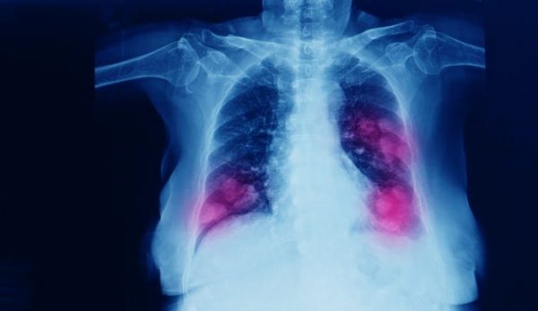 La edición genética podría desactivar uno de los principales culpables del cáncer de pulmón