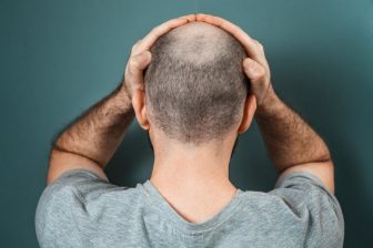 La terapia celular abre una nueva vía para acabar con la calvicie