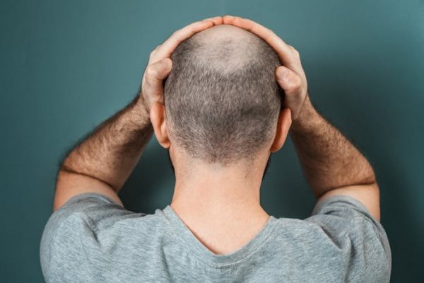 La terapia celular abre una nueva vía para acabar con la calvicie